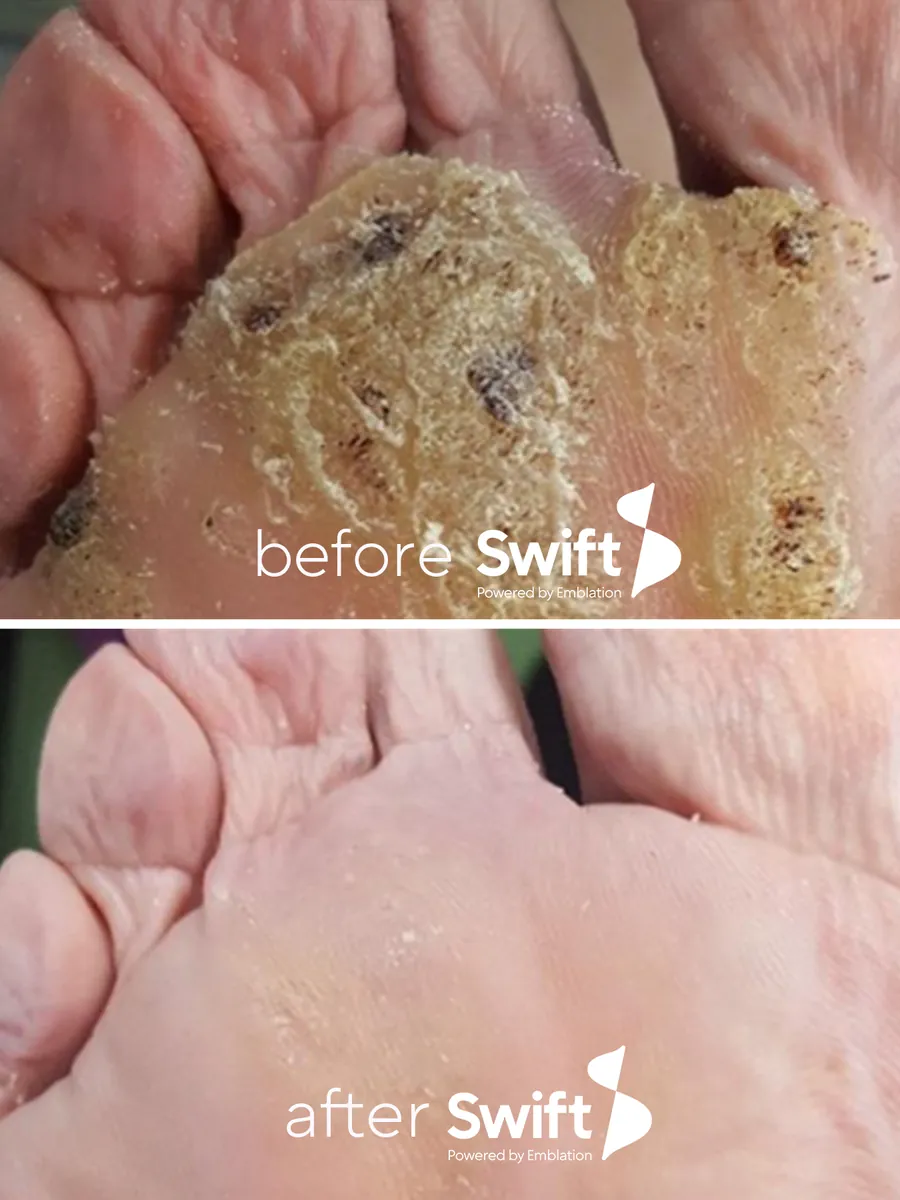 A cluster of plantar warts across the ball of the foot before Swift, and the same skin clear after