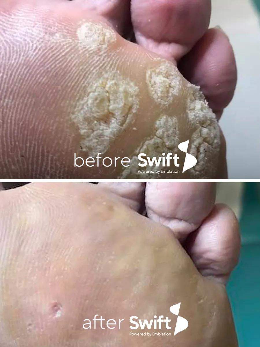 Several raised plantar warts under the toes before Swift, and smooth skin after
