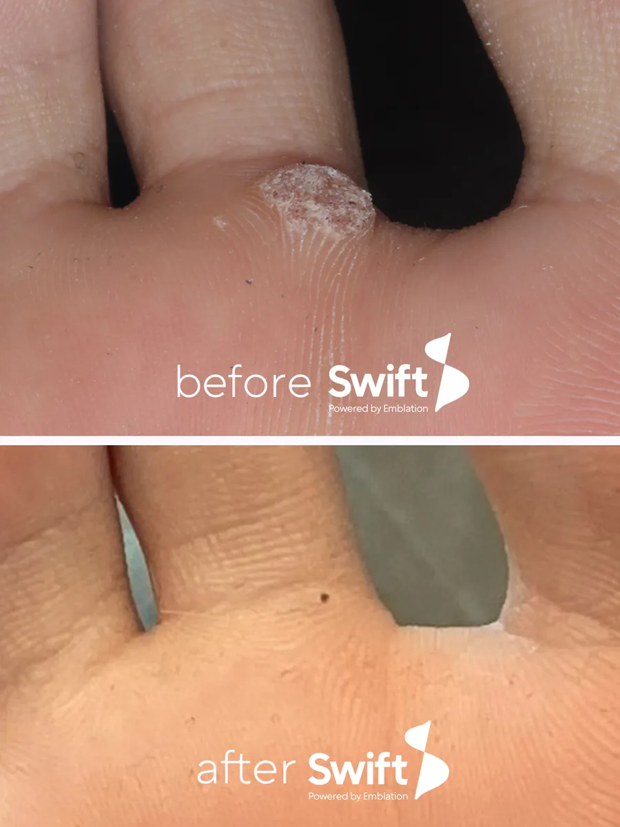 A wart in the crease under a toe before Swift, and clear skin after