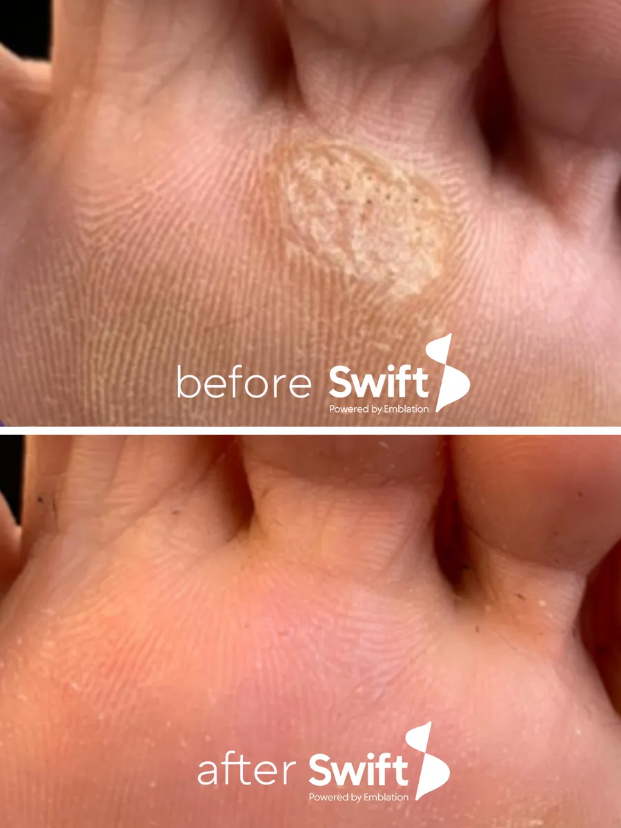 A single plantar wart on the ball of the foot before Swift, and clear skin after
